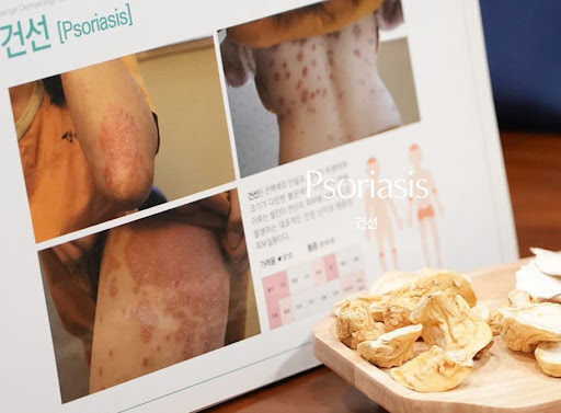 생기한의원이 설명하는 건선 증상 범위가 넓어질 때 확인할 것